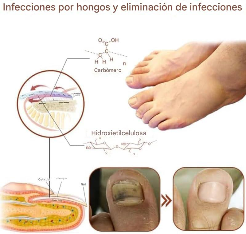 LASER PARA ELIMININACIÓN DE HONGOS EN LAS UÑAS